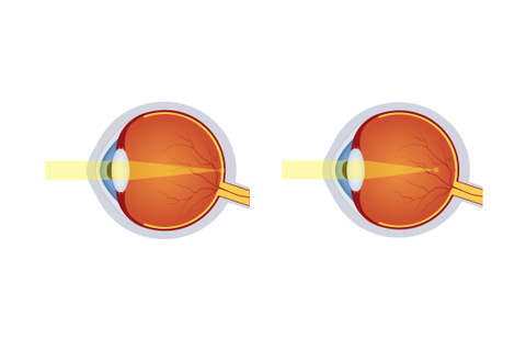 近視リスクを低減